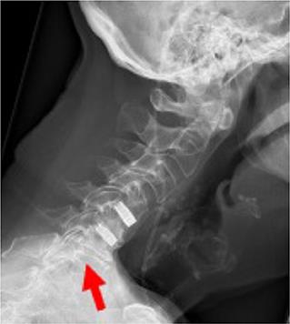 Complete Osseointegration of a Retrieved 3-D Printed Porous Titanium Cervical Cage